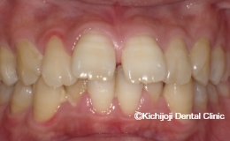 空隙歯列（すきっ歯）の矯正実例（治療前）