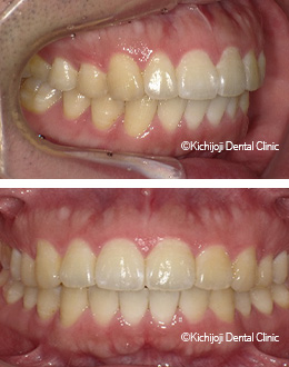 上顎前突 出っ歯 治療実例 マウスピース矯正 裏側矯正の矯正歯科 吉祥寺デンタルクリニック