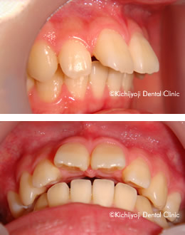 上顎前突 出っ歯 治療実例 マウスピース矯正 裏側矯正の矯正歯科 吉祥寺デンタルクリニック