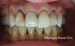 審美歯科の治療前1
