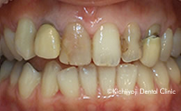 審美歯科の治療前2