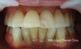 審美歯科の治療前3