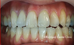 審美歯科の治療後4