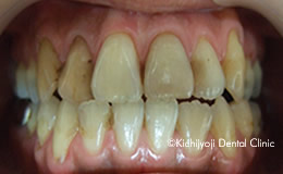 審美歯科の治療前4