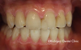 審美歯科の治療前5