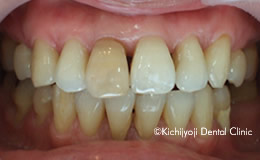 審美歯科の治療前6