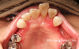 審美歯科の治療前8