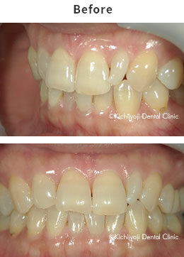 小さい歯とデコボコの治療実例 before