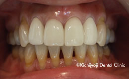 審美歯科の治療後1