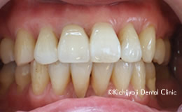 審美歯科の治療後6